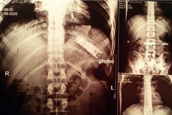 صورة طبيب يستخرج هاتف من بطن سجين ويكشف مفاجأة: مازال يعمل بعد 6 شهور